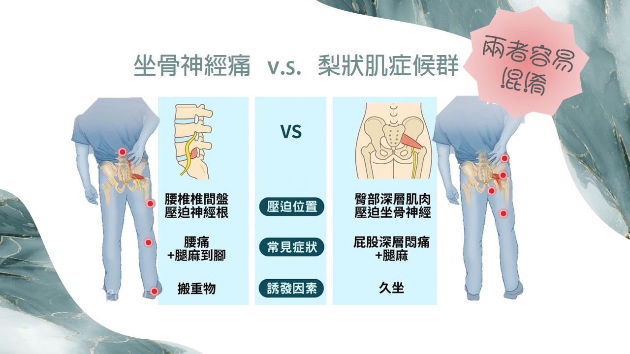 梨狀肌症候群示意圖 2